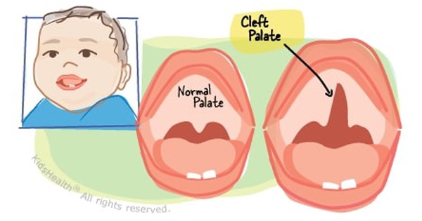 Cleft Palate