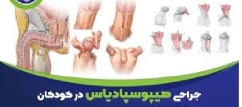 Hypospadias
